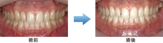 ホームホワイトニング 術前・術後